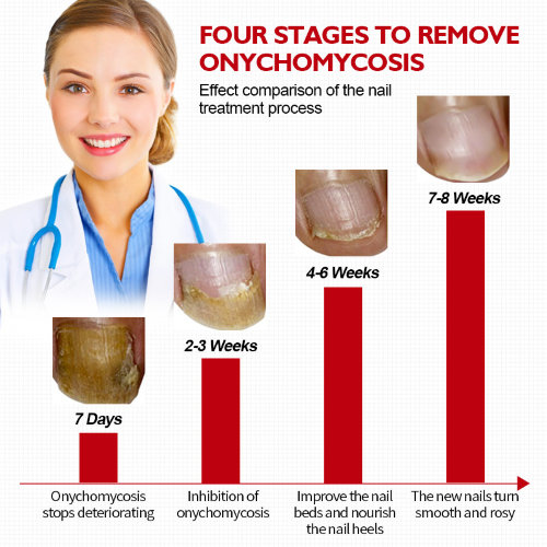 Vibrant Glamour Nail Fungus Solution Средство от грибка ногтей, лечение онихомикоза, 15мл